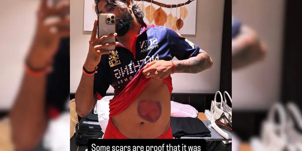 Krunal Pandya Shows His Battle Scars After Match-Winning 73 Against Mumbai Indians